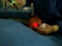 Smartlipo MPX by Dr Ayoubi, Chin Area