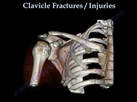 clavicular - This fracture clavicle collar bone video is an animated educational video for the clavicle bone ,its anatomy the injury ,the symptoms and findings, the value...