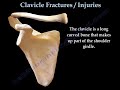 CLAVICLE FRACTURE  treatment and repair - Everything You Need To Know - Dr. Nabil Ebraheim
