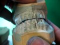 Identifying Occlusal Interferences \ Identifying Occlusal Interferences \
