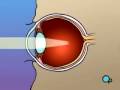 lasik general information
