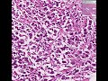 Histopathology Ovary--Dysgerminoma