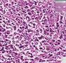 Histopathology Ovary--Dysgerminoma