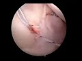 shoulder-arthroscopy-dr-allan-mishra-emedxcom.html