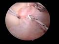 my-shoulder-surgery