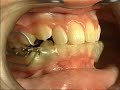 PUL increasing mandibular advancement