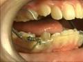 PUL  increasing mandibular advancement