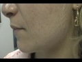 The Acne Practice  (Home Version 11)