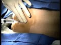 Caudal technique