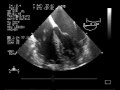 echocardiogram endocarditis:TEE:vegetation on the pacemaker lead