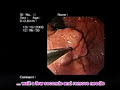 Glue injection of gastric varices