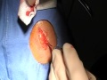 Lipomas fat tissue removal 11-8-10.MOD