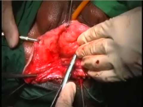 how to cure with vault