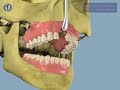 cirugia protesis dental - microdent systems s.l.