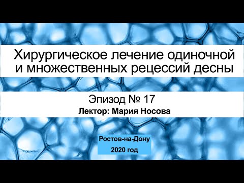 Лечение рецессии десны Часть 17. Ростов-на-Дону 2020 год