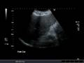 Coronal AVI