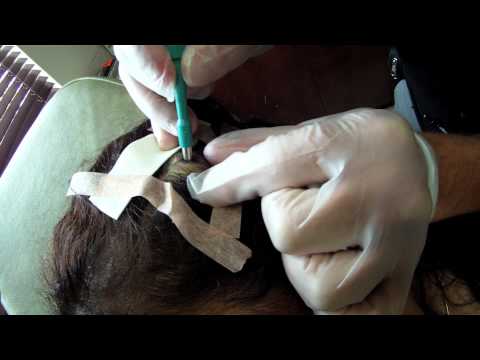 how to drain cyst on scalp