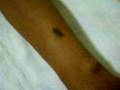 ENFERMEDAD DE CHAGAS (TRIPANOSOMA CRUZI)