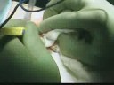 Part 1 Clavicle Surgery 7/7/08 Part 1 Clavicle Surgery 7/7/08