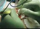Part 1 Clavicle Surgery 7/7/08