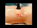 Lipo-Ease lose inches without surgery 1-800-B-YOUTHFUL