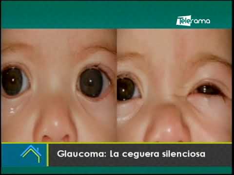 Glaucoma: La ceguera silenciosa