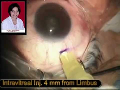 Видео Авастин в лечении ВМД