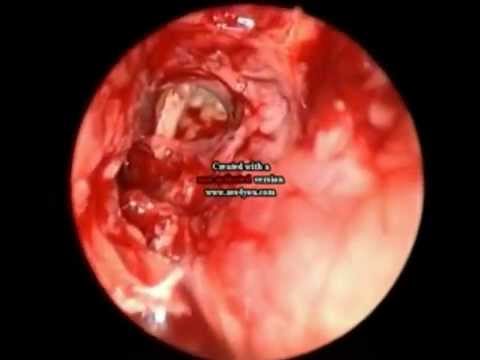 how to repair csf leak