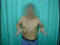 Severe Supraspinatus Tear Severe Supraspinatus Tear