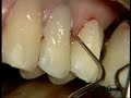 Class V restoration Dr. P. Colon - Dyract eXtra /2
