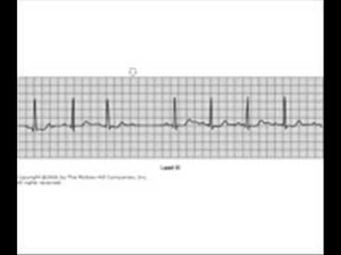how to treat 3rd degree heart block