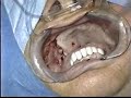 Dental Implants Posterior Maxilla Dental Implants Posterior Maxilla