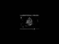 Echocardiogram - ultrasound