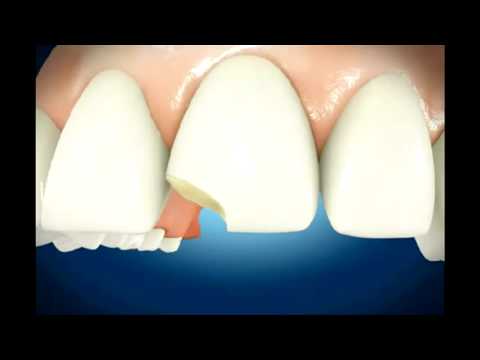 how to rebuild teeth