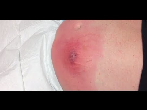 how to drain cellulitis