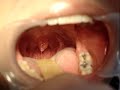 Uvula Bifida (En Forma de Vibora)