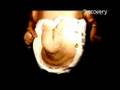 Human Mutation- Mermaid Syndrome