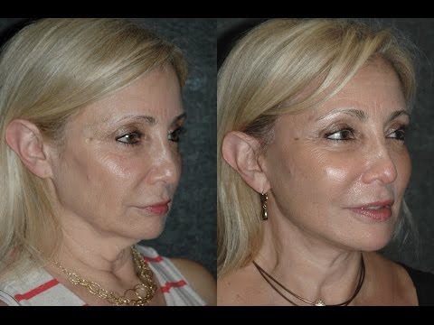 how to eliminate turkey neck without surgery
