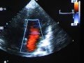 Severe Mitral Valve Prolapse