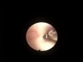 Intraoperative Proccedure Of Lamina Terminalis Fenestration From The Third Cerebral Ventricle Access - Part 1