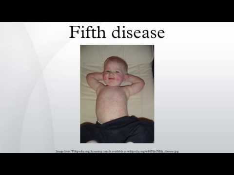 how to treat 5th disease