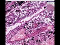 Histopathology Lymph node--Anthracosis, tuberculosis