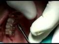 Orthodontic mini-screws placement