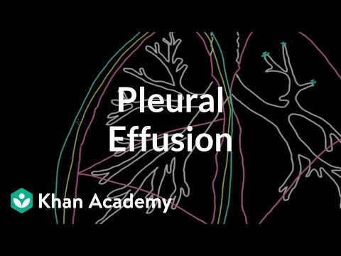 how to treat pleural effusion