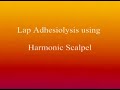 Laparoscopy Adhesiolysis Video ( Lap Adhesions Surgery Adhesions