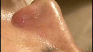 video thumbnail Aqua Peel, Korea beauty machine, AHA / BHA / Moisture, Exfoliating care, Blackheads care youtube