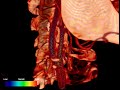3D visualization of Simulated Blood Flow 3D visualization of Simulated Blood Flow