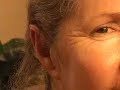 PLASTIC SURGERY JOURNEY:  OTOPLASTY (EAR PINNING) RECOVERY
