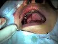 Immediate Dental Implant Placement ?????? PERFECT SURGERY!!!