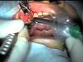 Immediate Dental Implant Placement 立即植牙示範 PERFECT SURGERY!!!